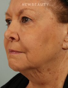 Dr. Kenneth Beer - CoolSculpting - Before