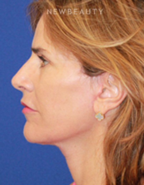 Dr. Dilip Madnani - Facelift - After