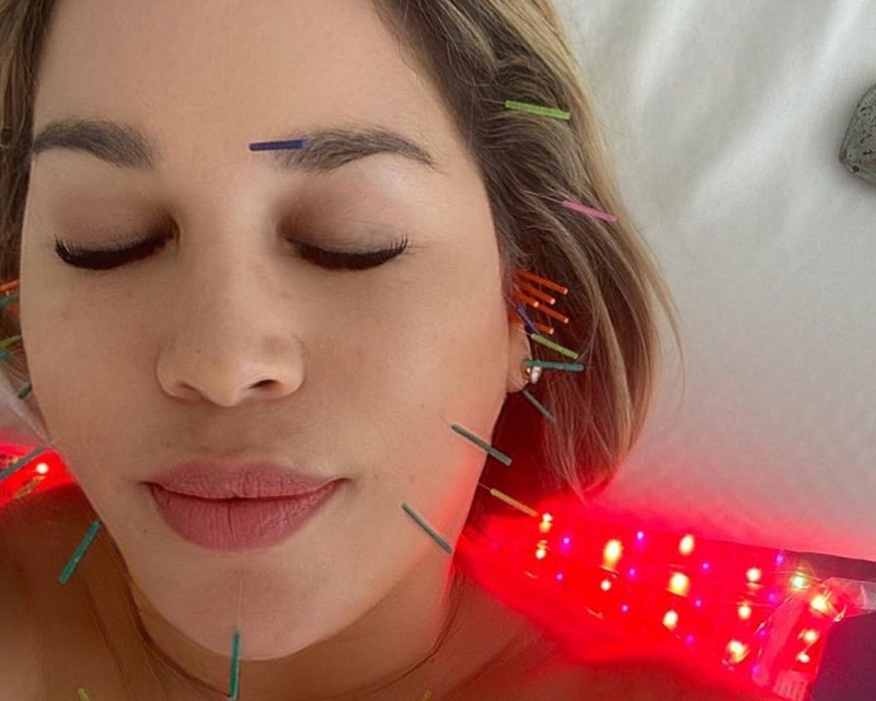 How This Acupuncture Treatment Can Help Recontour Your Face
