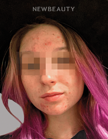 Dr. Anna Chacon - Acne - 34285017 - Before