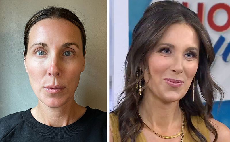 jawline filler before after