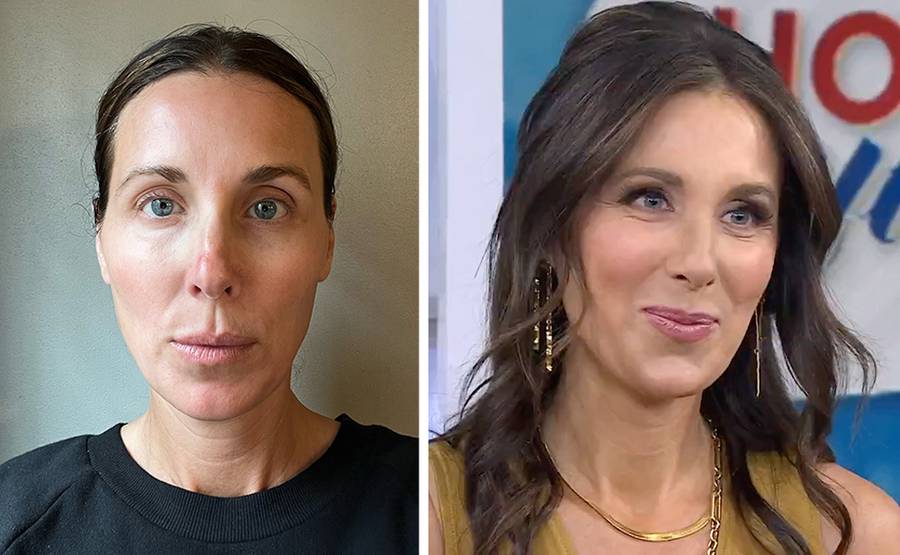 jawline filler before after