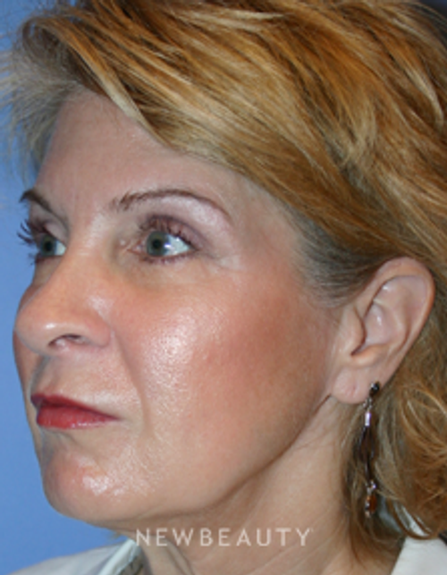 Dr. Kelly Bomer, Injections/Liquid Lift, Lip Augmentation - After