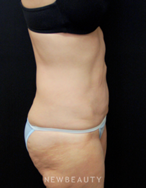 Dr. Mokhtar Asaadi Liposuction - After