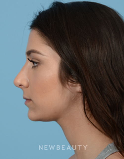 Dr. Jeffrey B. Wise - Rhinoplasty - After