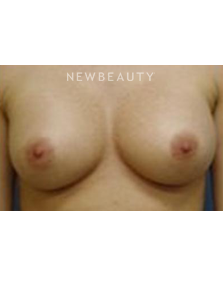 Dr. Roman Rayham - Breast Augmentation - After