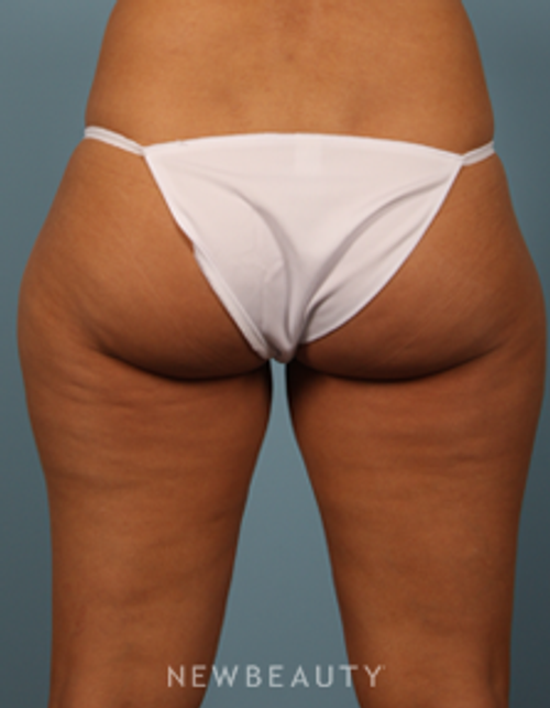 Dr. Carmen Kavali - Velashape - After