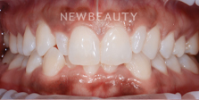 Dr. Nathan Hoffman - Invisalign, Teeth Whitening & Veneers - Before