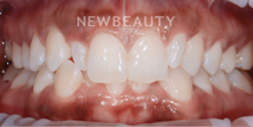 Dr. Nathan Hoffman - Invisalign, Teeth Whitening & Veneers - Before