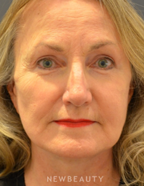 Dr. B. Aviva Preminger - Facelift & Necklift - After