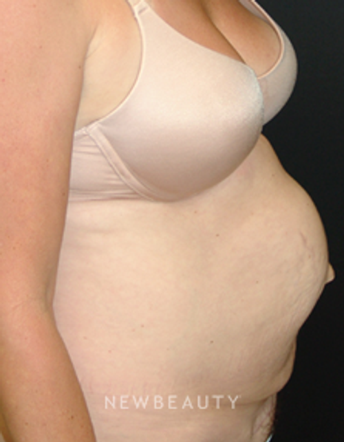 Dr. Mokhtar Asaadi Liposuction, Tummy Tuck - Before