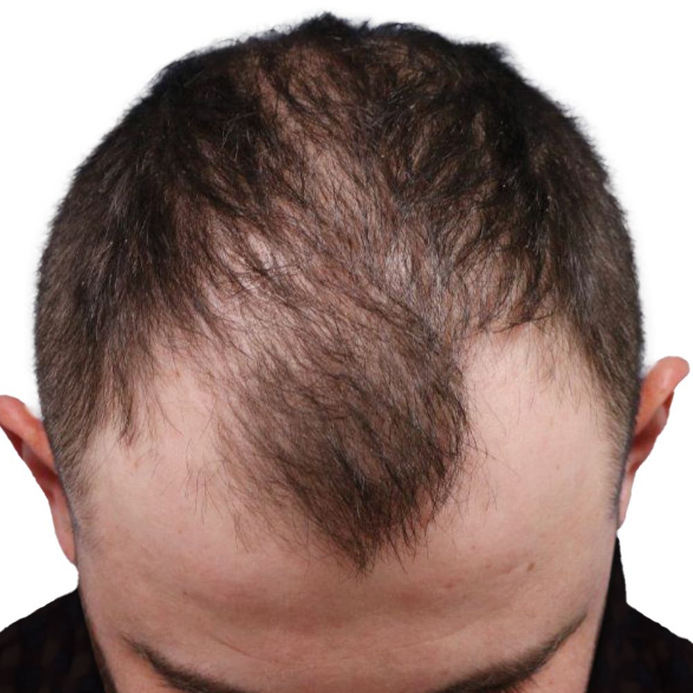 Before hair transplant