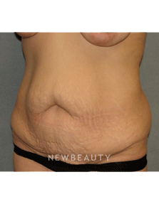 Dr Sean Simon Tummy Tuck, Lipo - Before