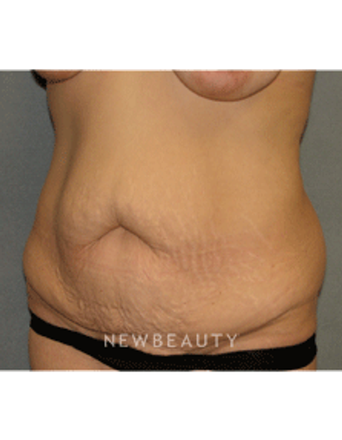 Dr Sean Simon Tummy Tuck, Lipo - Before
