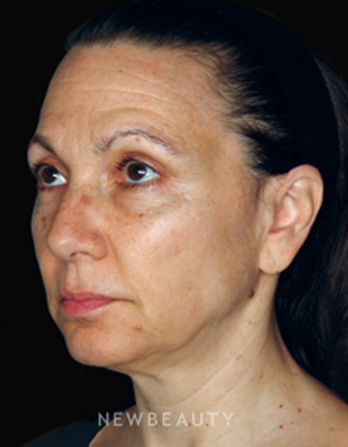 Dr. Doris Day - Injectables & Fillers - Before