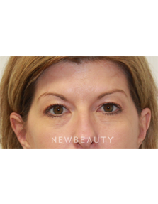 Dr. Dilip D. Madnani - Eyelift - Before