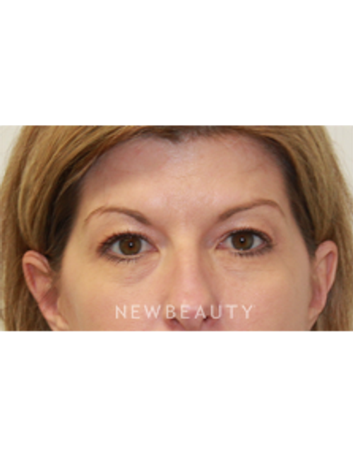 Dr. Dilip D. Madnani - Eyelift - Before
