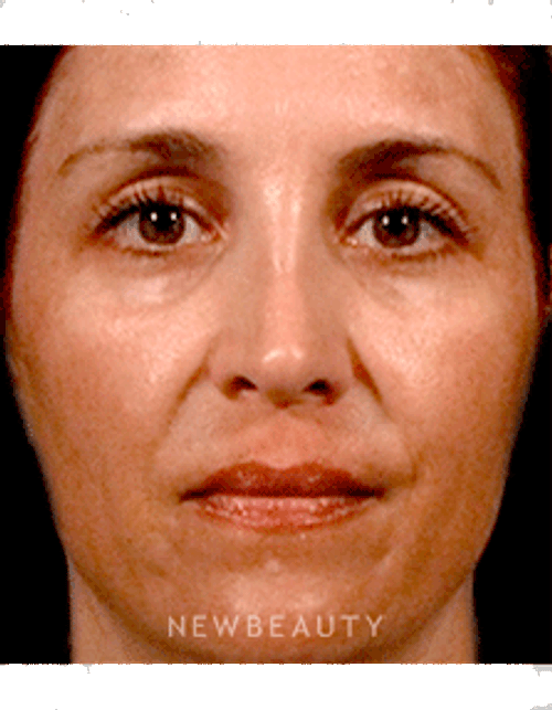 Dr. Alster Tanzi McGregor Lasers - Before