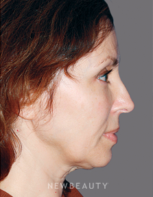 Dr. Konstantin Vasyukevich Facelift, Necklift - Before
