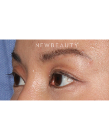 Dr. Lily Lee - Asian Eyelid Revision Surgery - Before