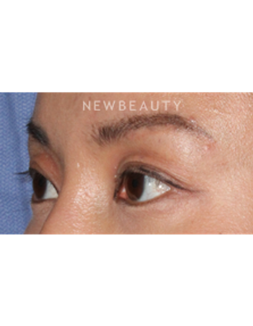 Dr. Lily Lee - Asian Eyelid Revision Surgery - Before