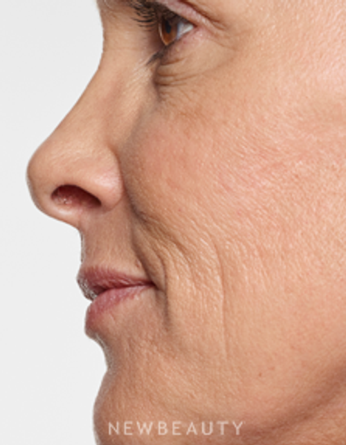 Dr. Marina Peredo - Lip Enhancement - Before