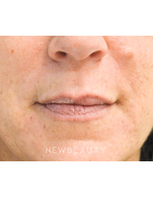 Dr. Julie Russak Injectables & Fillers - After