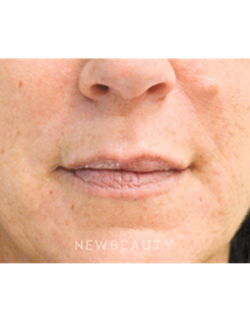 Dr. Julie Russak Injectables & Fillers - After