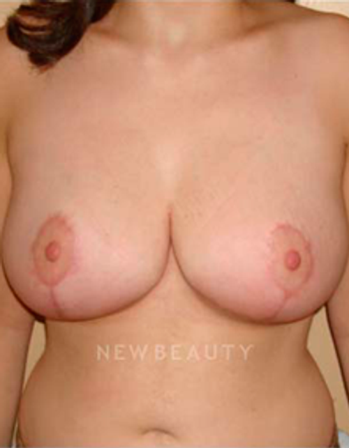 Dr. Michael Horn Breast Reduction - After
