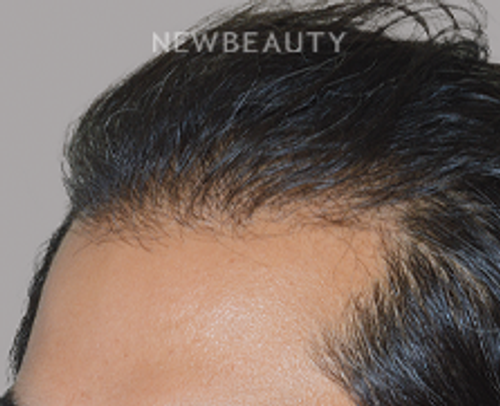 Dr. Anthony Bared - Hair Transplant - 46164563 - After