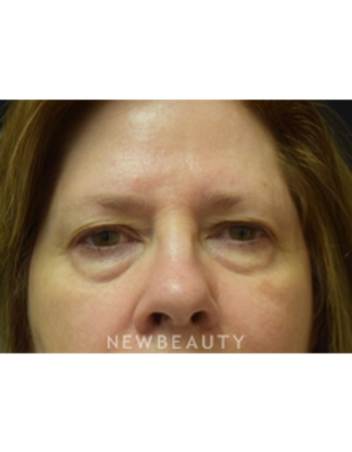 Dr. Jeffrey B. Wise - Blepharoplasty - Before