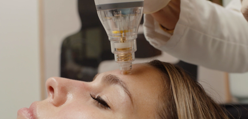 5 Things You Didn’t Know RF Microneedling Could Do For Your Skin