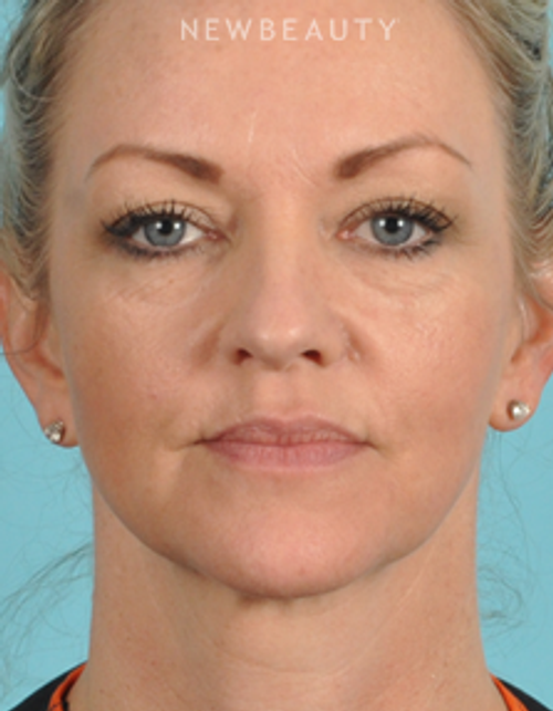 Dr. Bradley Bengtson - Injectables & Fillers - Before