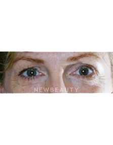 Dr. Lee Ann Klausner Blepharoplasty - Before