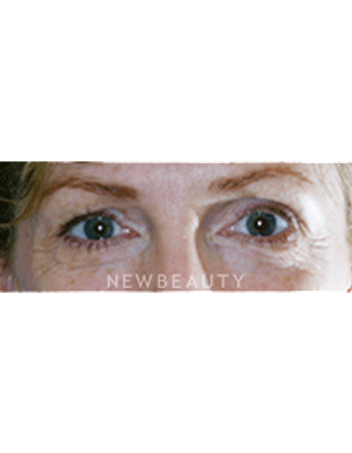 Dr. Lee Ann Klausner Blepharoplasty - Before