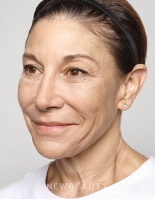 Dr. Ava Shamban - Facial Rejuvenation - After
