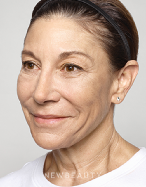 Dr. Ava Shamban - Facial Rejuvenation - After