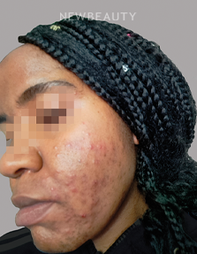 Dr. Anna Chacon - Acne - 34284242 - Before
