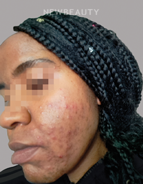 Dr. Anna Chacon - Acne - 34284242 - Before