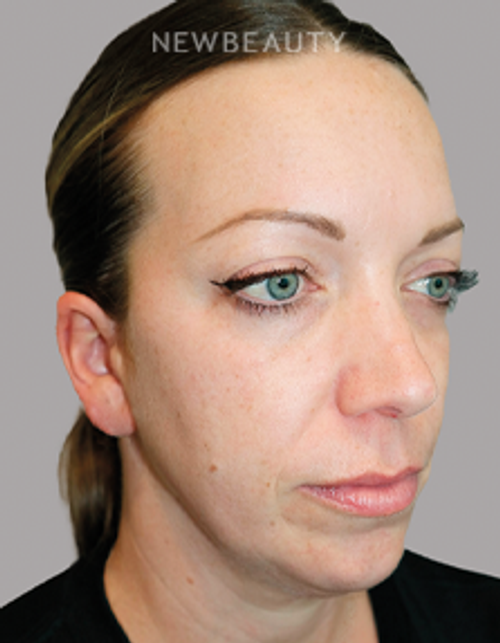 Dr. Sanjay Grover - Facelift - 49726612 - Before