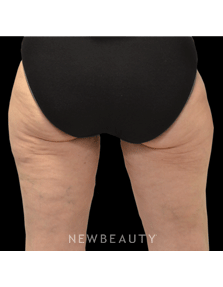 Dr. Julie Russak - CoolSculpting - After