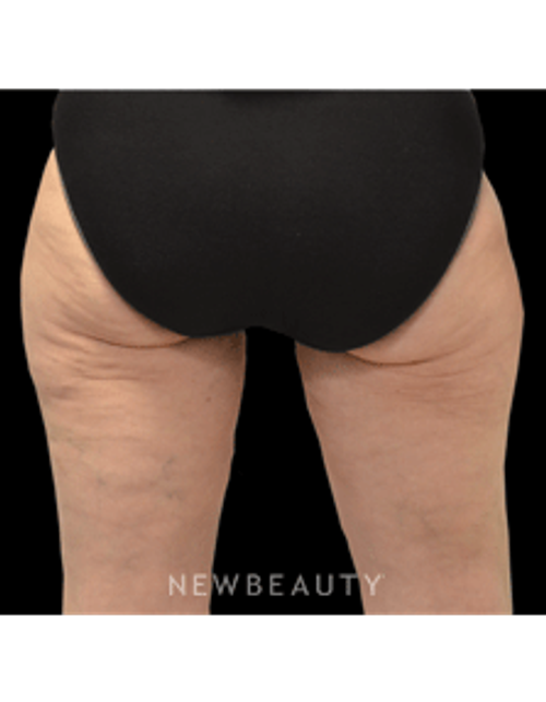 Dr. Julie Russak - CoolSculpting - After