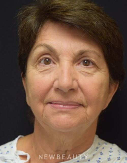 Dr. Jeffrey B. Wise - Facelift - Before