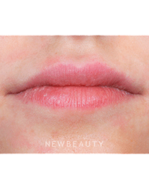 Dr. Marina Peredo Lip Augmentation - Before