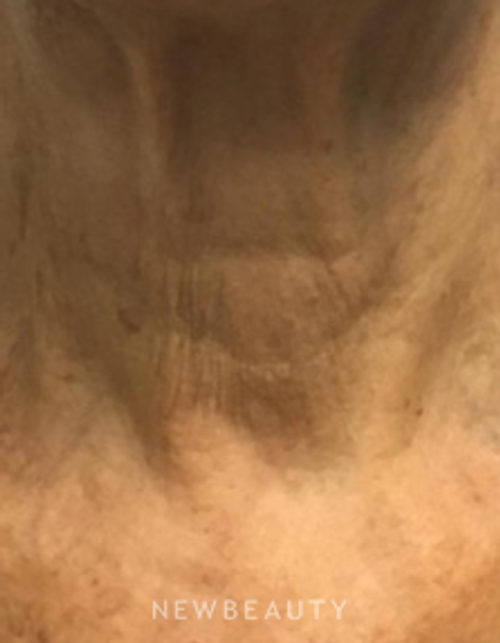 Dr. Marina Peredo - Botox - After