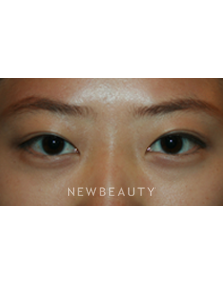 Dr. John Kang - Upper Blepharoplasty - After