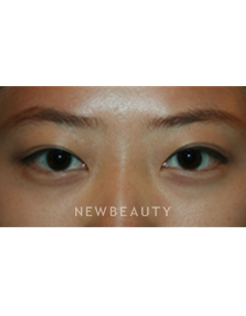 Dr. John Kang - Upper Blepharoplasty - After