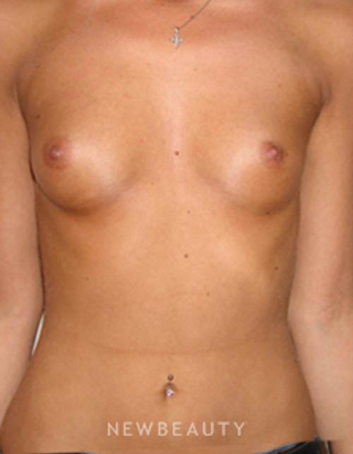 Dr. Michael Horn Breast Augmentation - Before