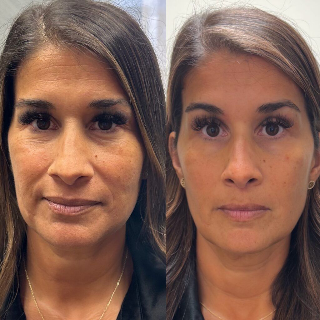 before and after filler