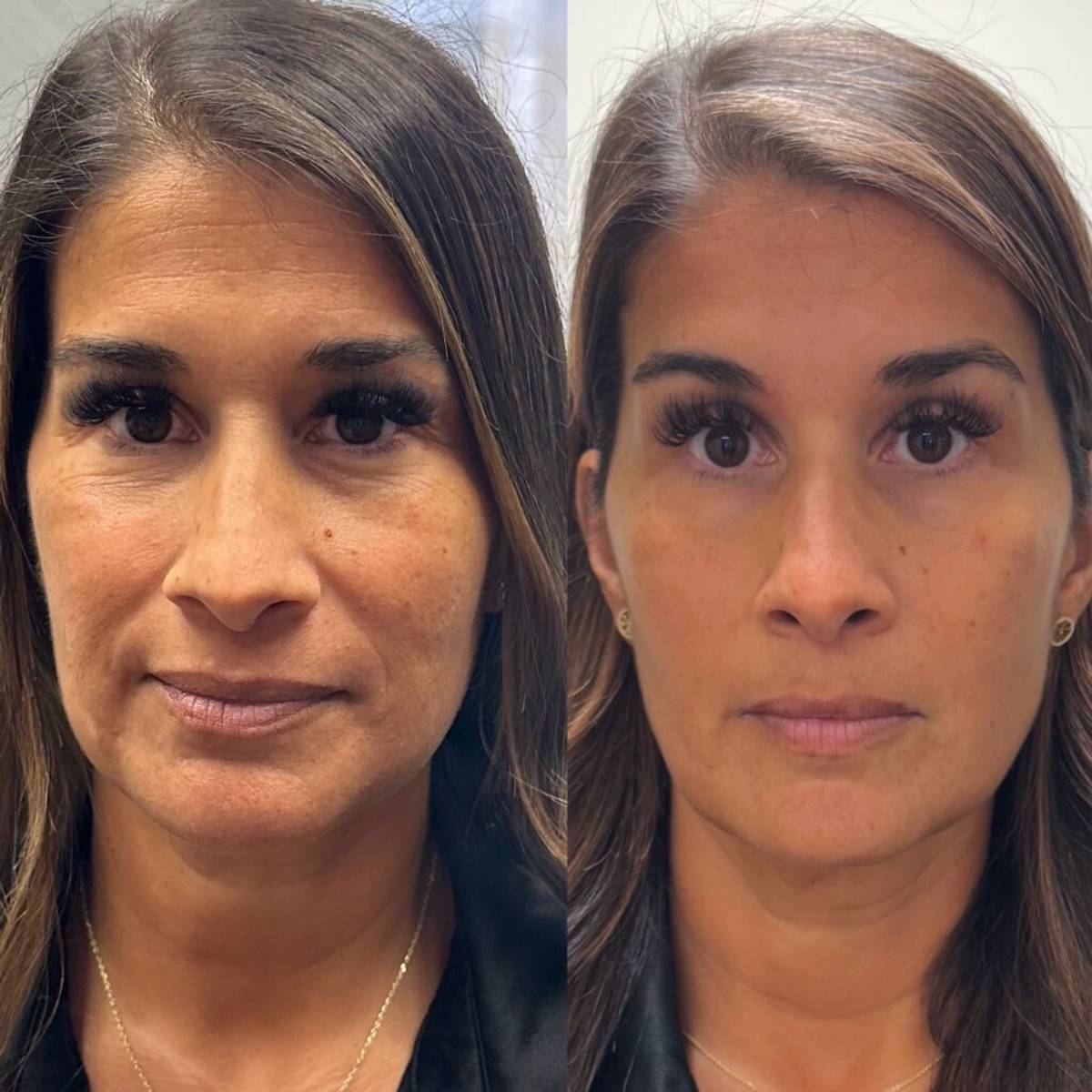 before and after filler